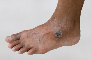 https://www.inmotionfootankle.com/images/services/calluses.jpg