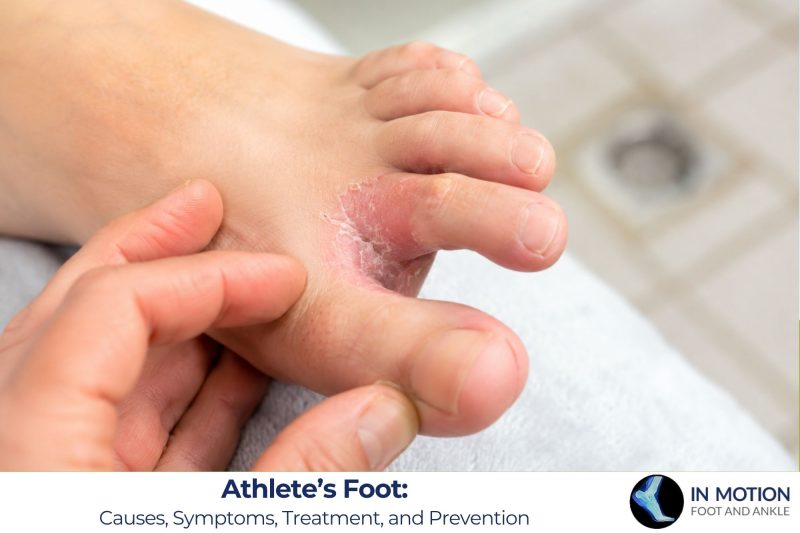 Athlete’s Foot: Causes, Symptoms, Treatment, and Prevention