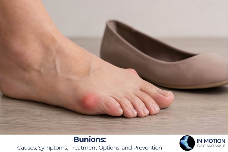 Bunions: Causes, Symptoms, Treatment Options, and Prevention