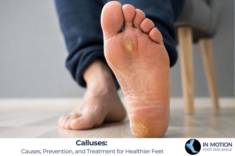 Calluses: Causes, Prevention, and Treatment for Healthier Feet