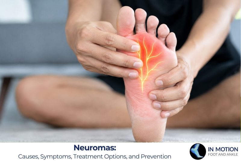 Neuromas Causes, Symptoms, Treatment Options, and Prevention