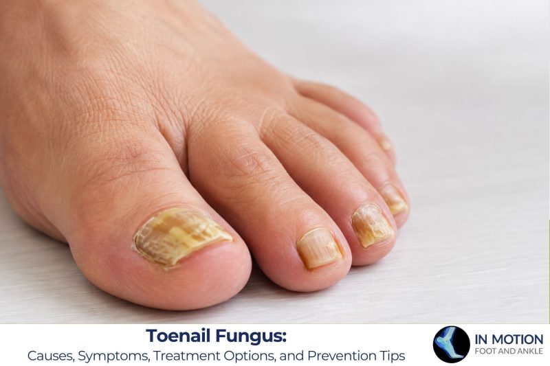 Toenail Fungus: Causes, Symptoms, Treatment Options, and Prevention Tips