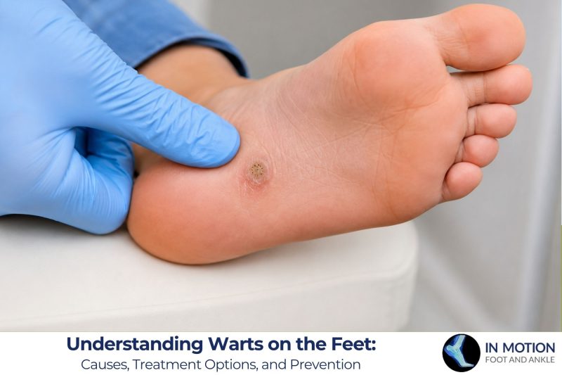 Understanding Warts on the Feet Causes, Treatment Options, and Prevention